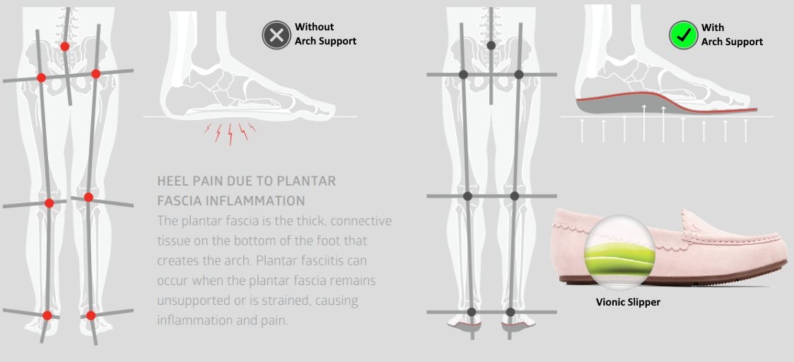 Vionic slippers discount for plantar fasciitis